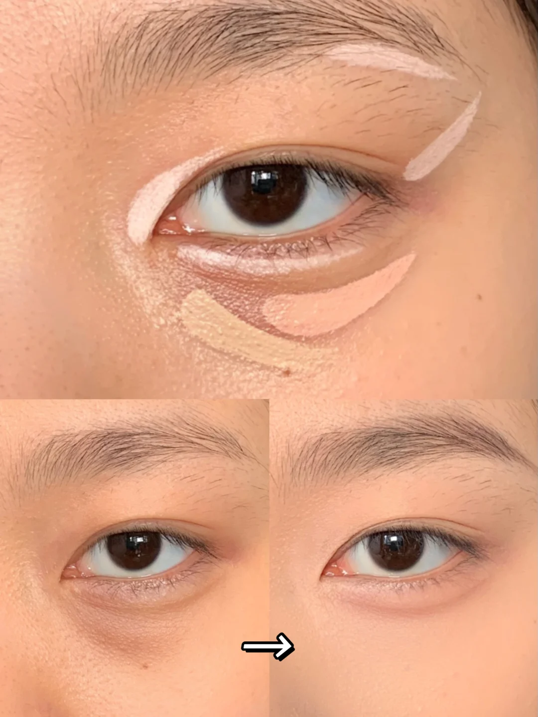 黑眼圈泪沟消失术！新手get妈生眼平整度