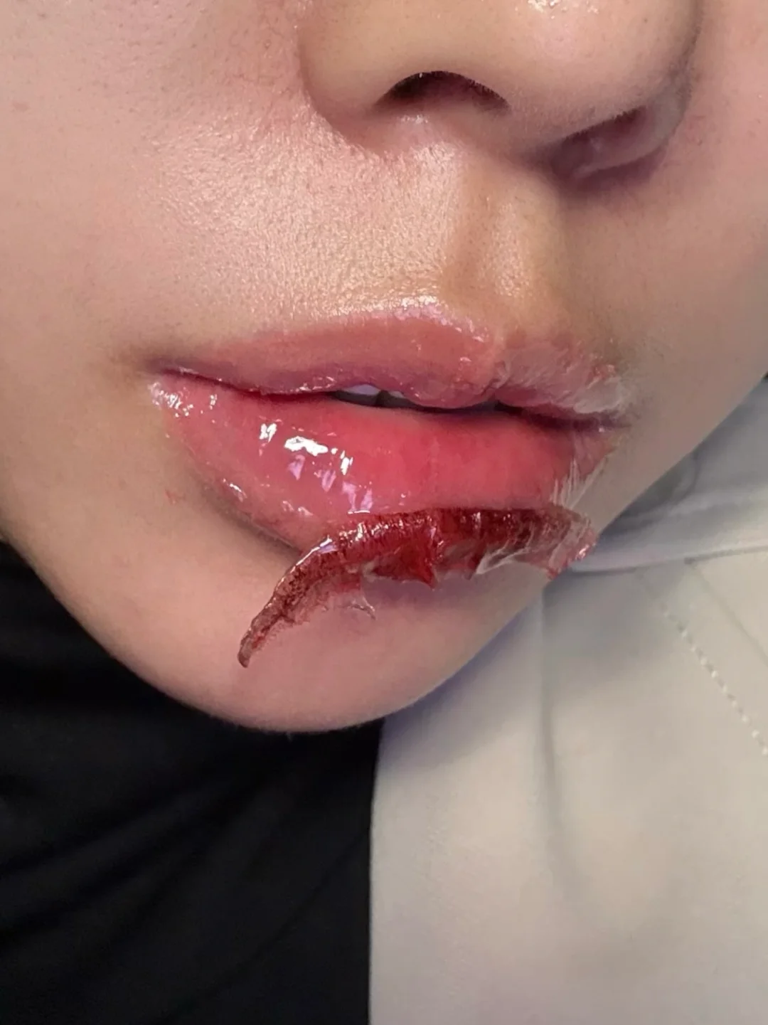 On the second day of lip tattooing, scabs began to fall off and obsessive-compulsive disorder couldn't bear it any longer
