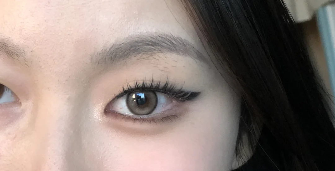 Single eyelid attempt with mild Asian eye sensitivity