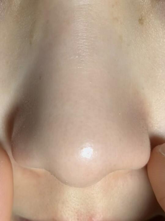 Persist in using physiological saline to remove blackheads for 47 days
